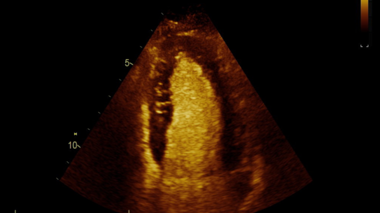 Echocardiogram photo